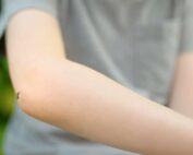 Mosquito sitting on boys arm